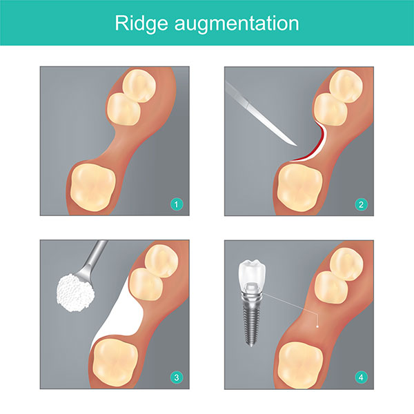 4 Graphics of the stages of Ridge Augmentation from Fairbanks Periodontal Associates in Fairbanks, AK