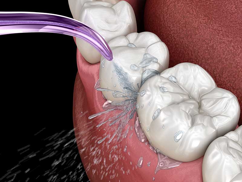 3D illustration of oral hygiene, waterlase service