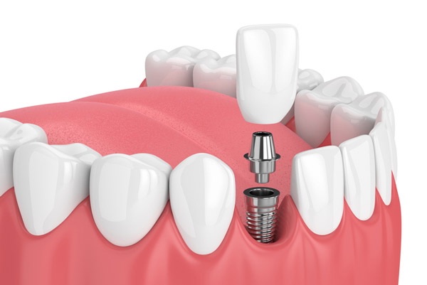 Rendering image of dental implant at Fairbanks Periodontal Associates in Fairbanks, AK