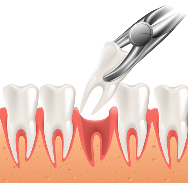 Rendered image of a tooth extraction from Fairbanks Periodontal Associates in Fairbanks, AK