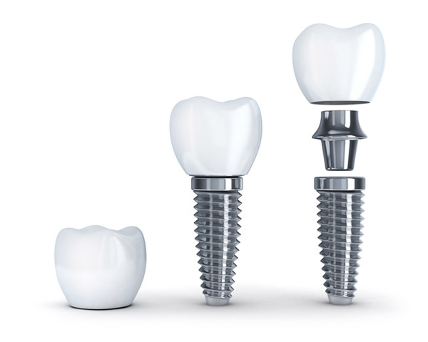 Diagram of single tooth implant with post at Fairbanks Periodontal Associates in Fairbanks, AK