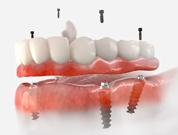 An upper arch All-on-4 dental implant system with screws being placed into the jawbone.