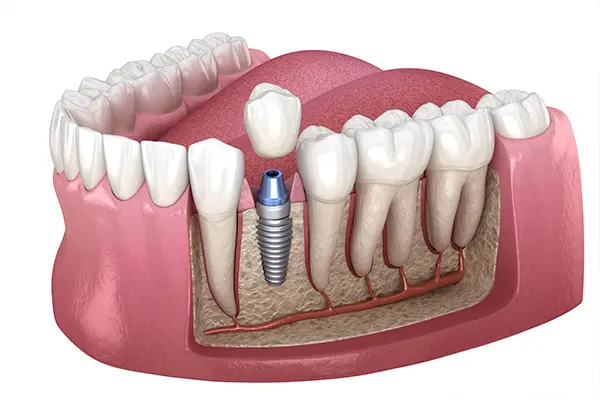 A cross-section of a dental implant integrated into the jawbone, illustrated by Fairbanks Periodontal Associates in Fairbanks, AK